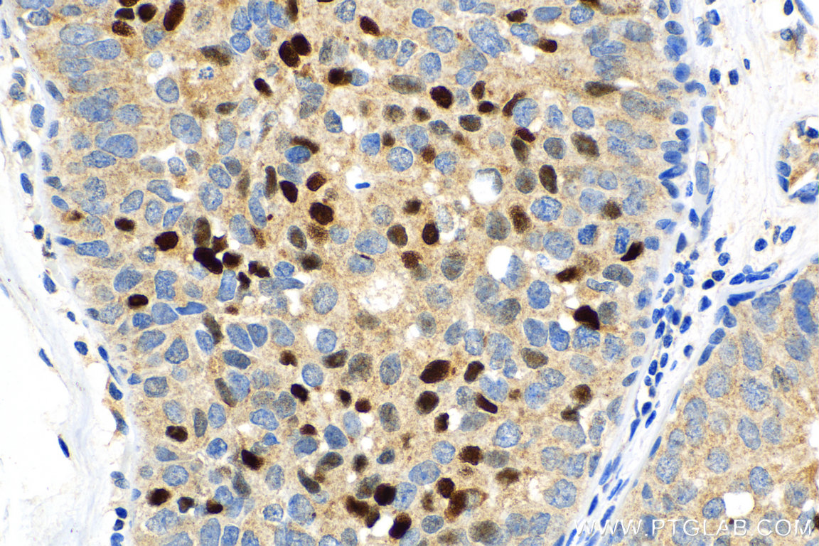 Immunohistochemistry (IHC) staining of human breast cancer tissue using PR Polyclonal antibody (25871-1-AP)