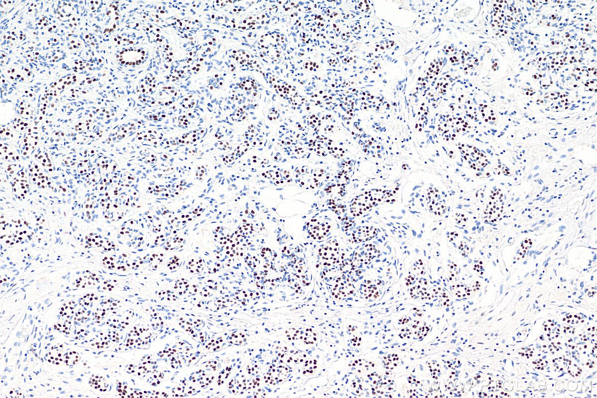 Immunohistochemistry (IHC) staining of human breast cancer tissue using PR Monoclonal antibody (66300-1-Ig)