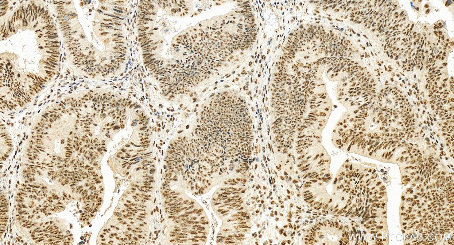 Immunohistochemistry (IHC) staining of human colon cancer tissue using PRDM5 Polyclonal antibody (14126-1-AP)