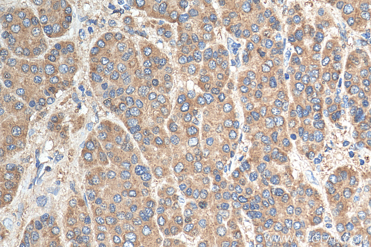 Immunohistochemistry (IHC) staining of human liver cancer tissue using PRDX3 Polyclonal antibody (55087-1-AP)