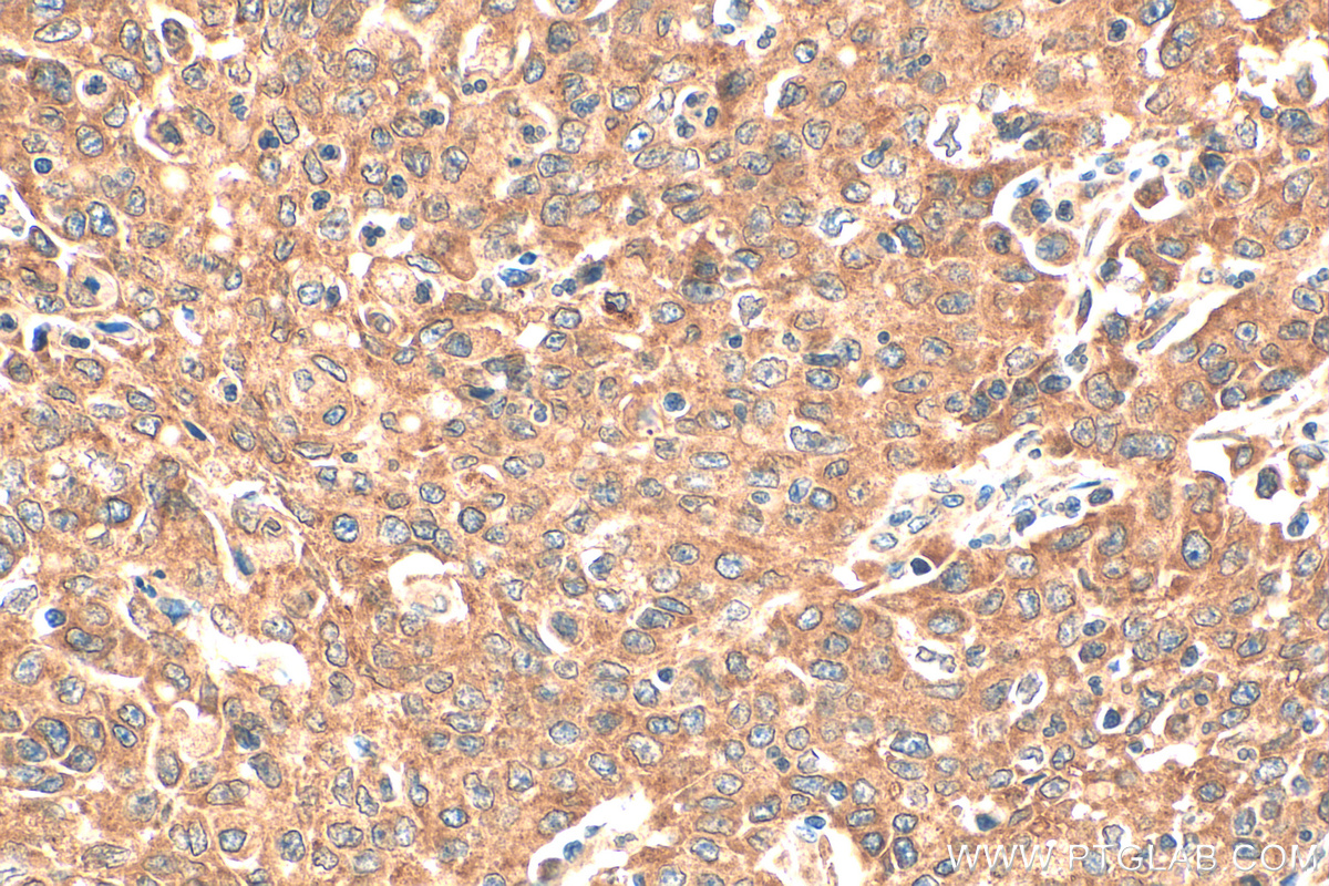Immunohistochemistry (IHC) staining of human stomach cancer tissue using PRDX3 Polyclonal antibody (55087-1-AP)