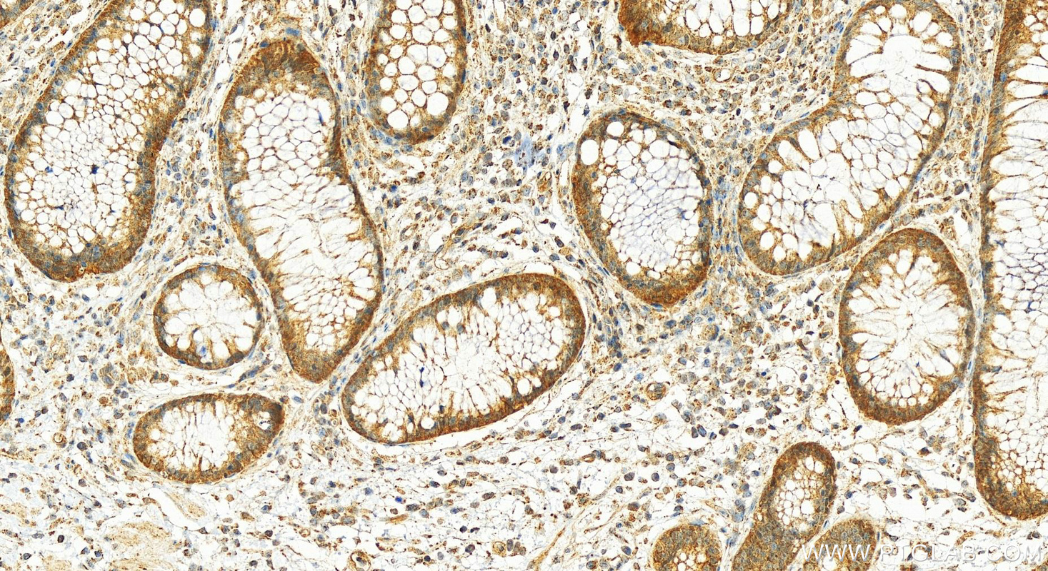 Immunohistochemistry (IHC) staining of human colon cancer tissue using PREP Polyclonal antibody (11536-1-AP)