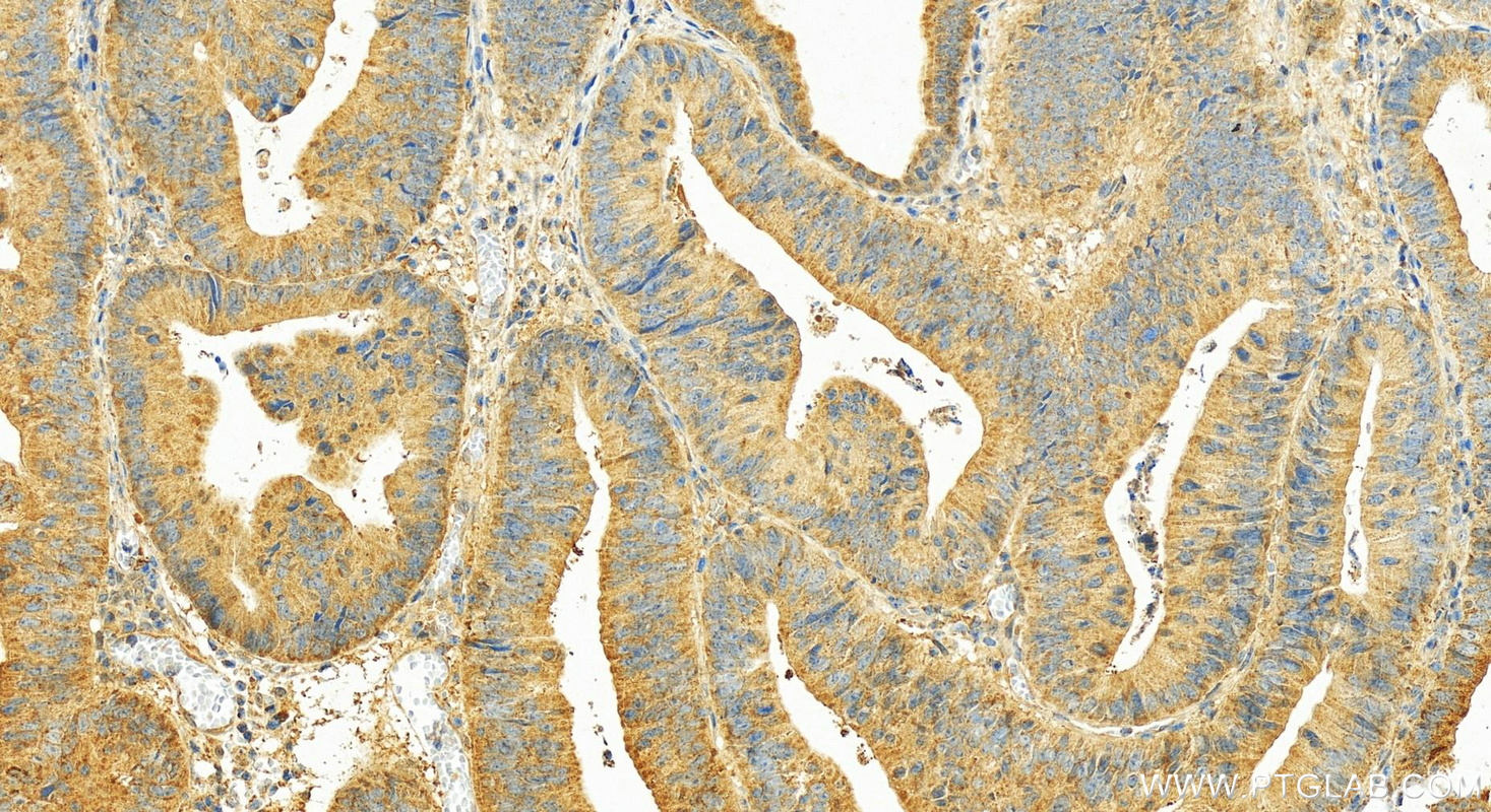 Immunohistochemistry (IHC) staining of human colon cancer tissue using PREP Polyclonal antibody (11536-1-AP)