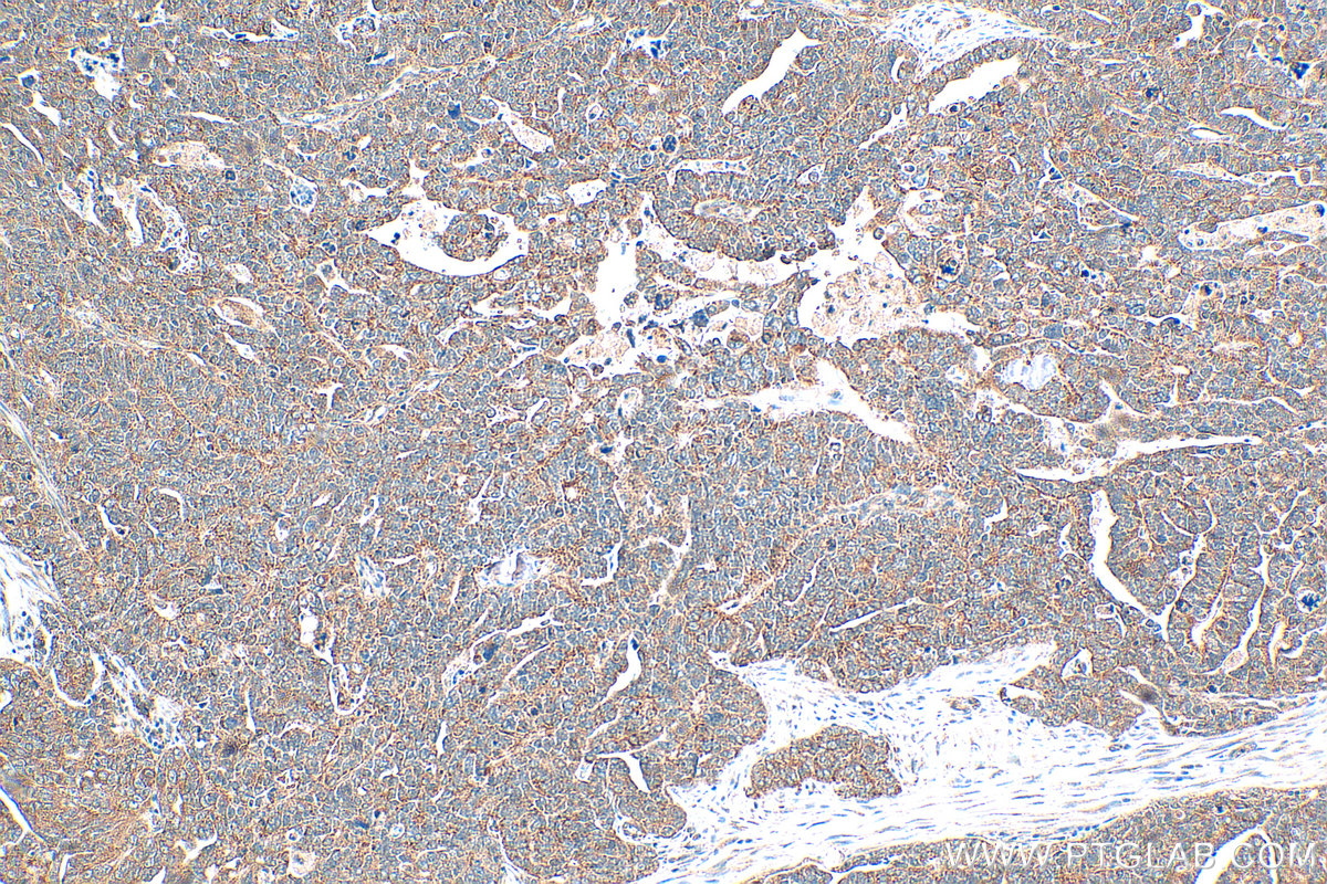 Immunohistochemistry (IHC) staining of human ovary tumor tissue using AMPK Gamma 2 Polyclonal antibody (12568-1-AP)