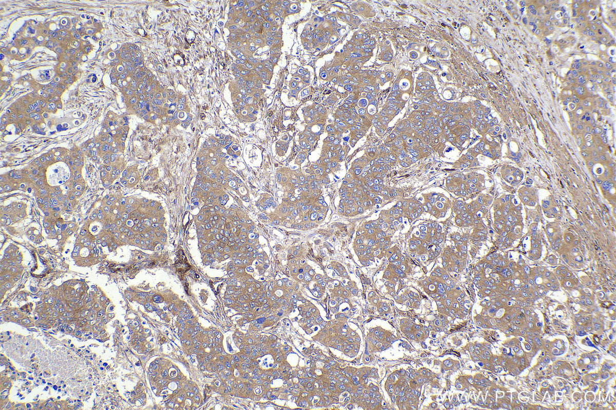 Immunohistochemistry (IHC) staining of human stomach cancer tissue using PRKAR1A Polyclonal antibody (20358-1-AP)