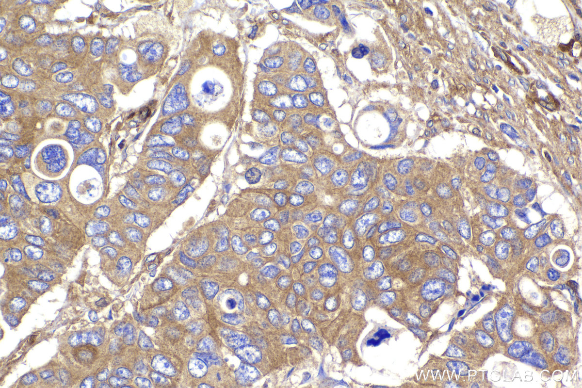 Immunohistochemistry (IHC) staining of human stomach cancer tissue using PRKAR1A Polyclonal antibody (20358-1-AP)