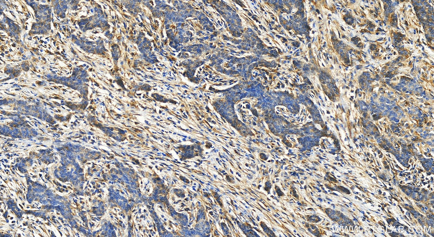 Immunohistochemistry (IHC) staining of human stomach cancer tissue using PRKAR2B Polyclonal antibody (20845-1-AP)