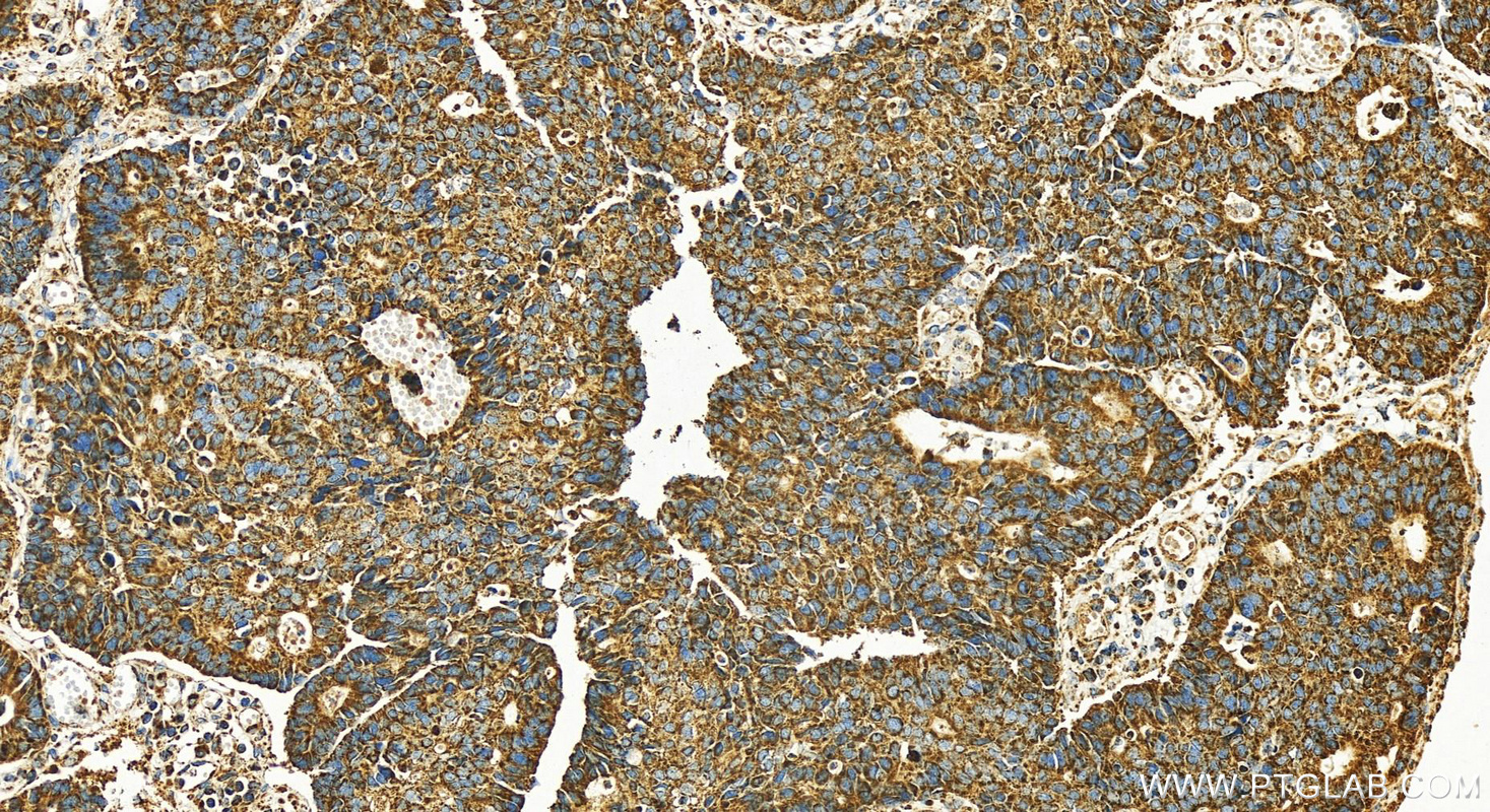 Immunohistochemistry (IHC) staining of human stomach cancer tissue using PRKAR2B Polyclonal antibody (28351-1-AP)