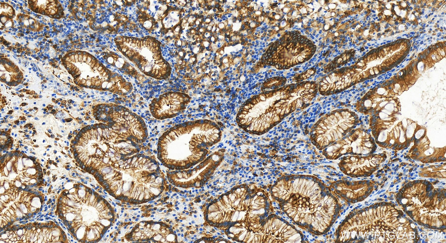 Immunohistochemistry (IHC) staining of human stomach cancer tissue using PKC Alpha Recombinant antibody (83840-6-RR)