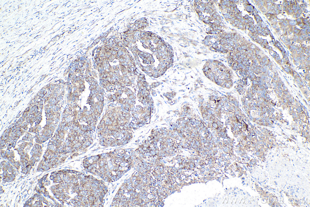 Immunohistochemistry (IHC) staining of human ovary cancer tissue using PRKRA Monoclonal antibody (68518-1-Ig)