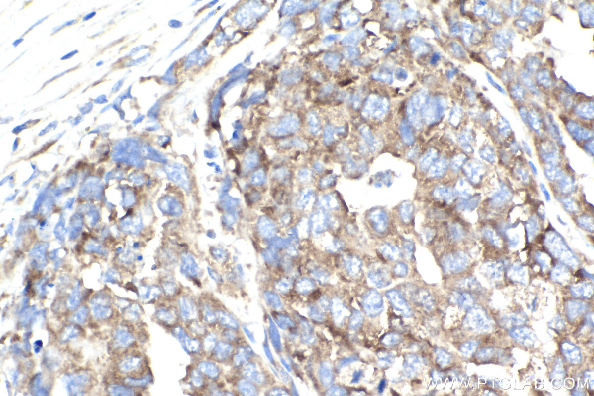 Immunohistochemistry (IHC) staining of human ovary cancer tissue using PRKRA Monoclonal antibody (68518-1-Ig)