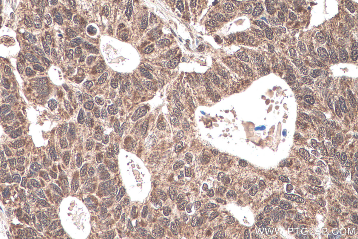 Immunohistochemistry (IHC) staining of human stomach cancer tissue using PRPF8 Polyclonal antibody (11171-1-AP)