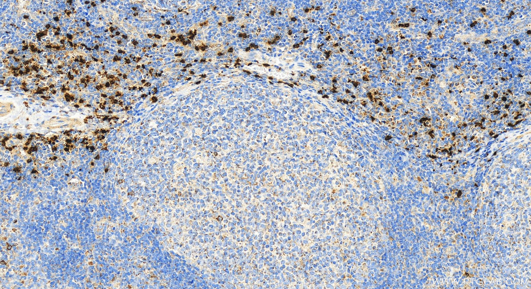 Immunohistochemistry (IHC) staining of human tonsillitis tissue using PRTN3 Polyclonal antibody (27153-1-AP)