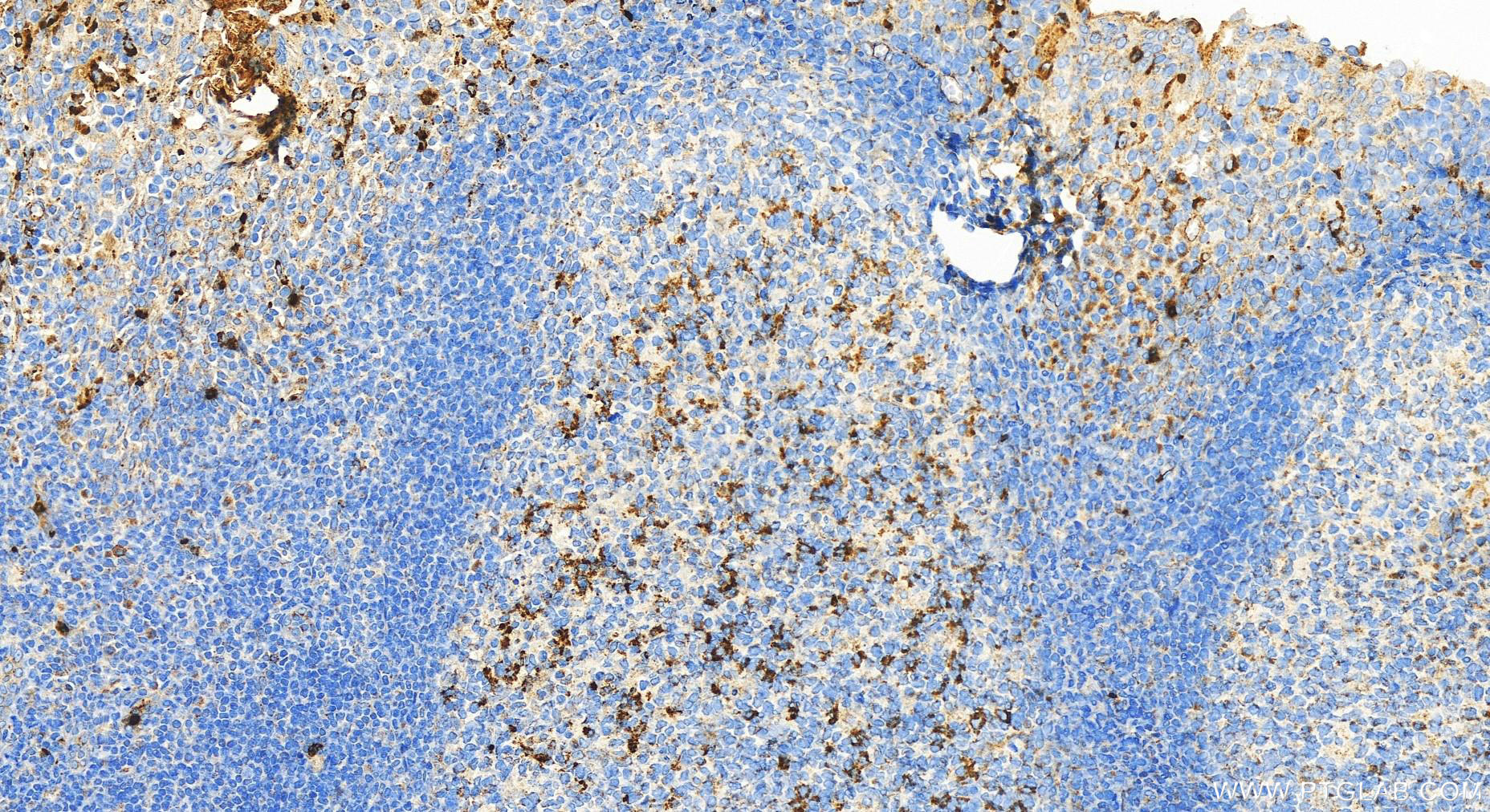 Immunohistochemistry (IHC) staining of human tonsillitis tissue using PRTN3 Polyclonal antibody (27153-1-AP)