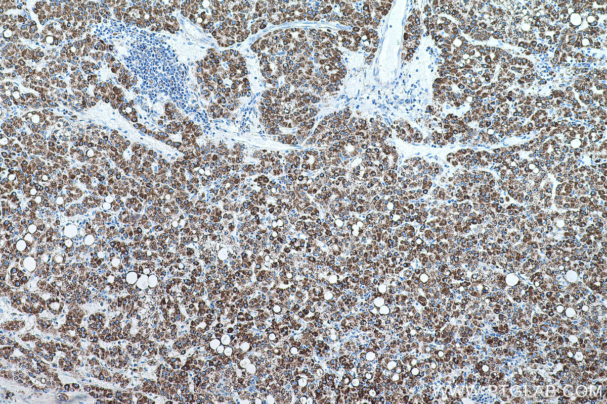 Immunohistochemistry (IHC) staining of human liver cancer tissue using PRDX3 Monoclonal antibody (66810-1-Ig)