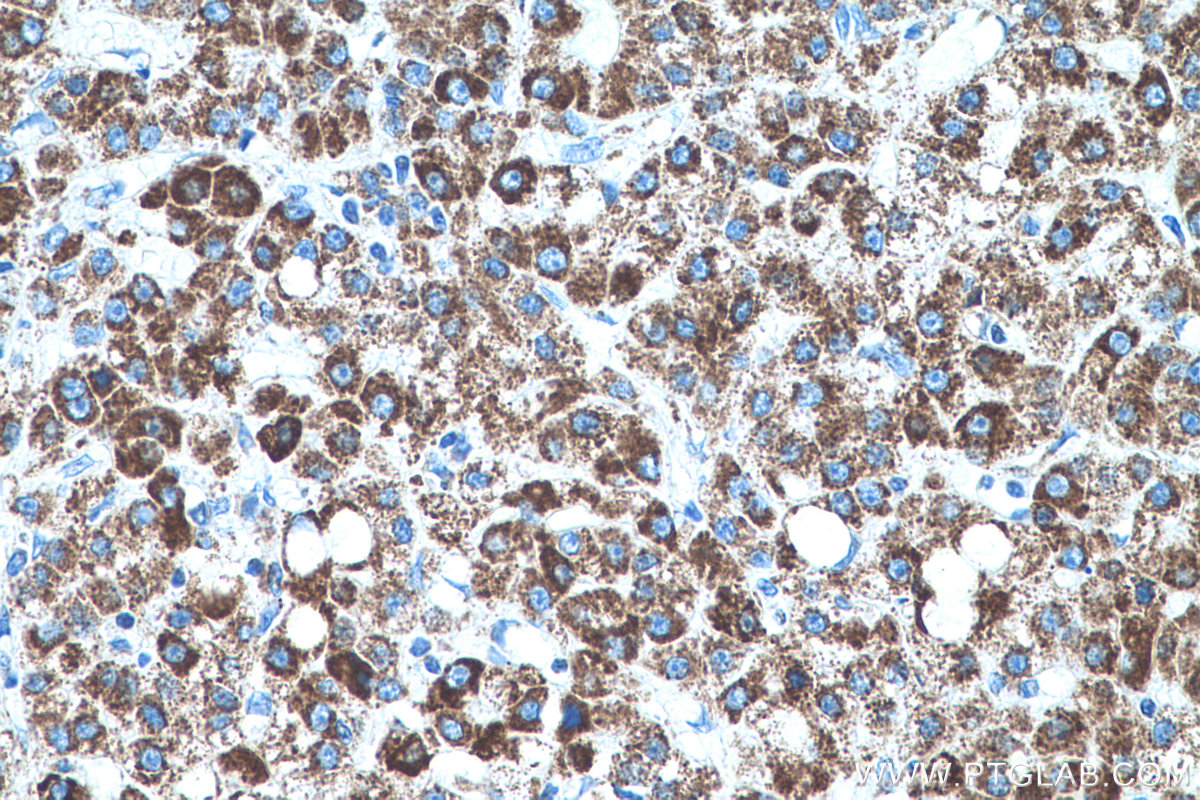 Immunohistochemistry (IHC) staining of human liver cancer tissue using PRDX3 Monoclonal antibody (66810-1-Ig)