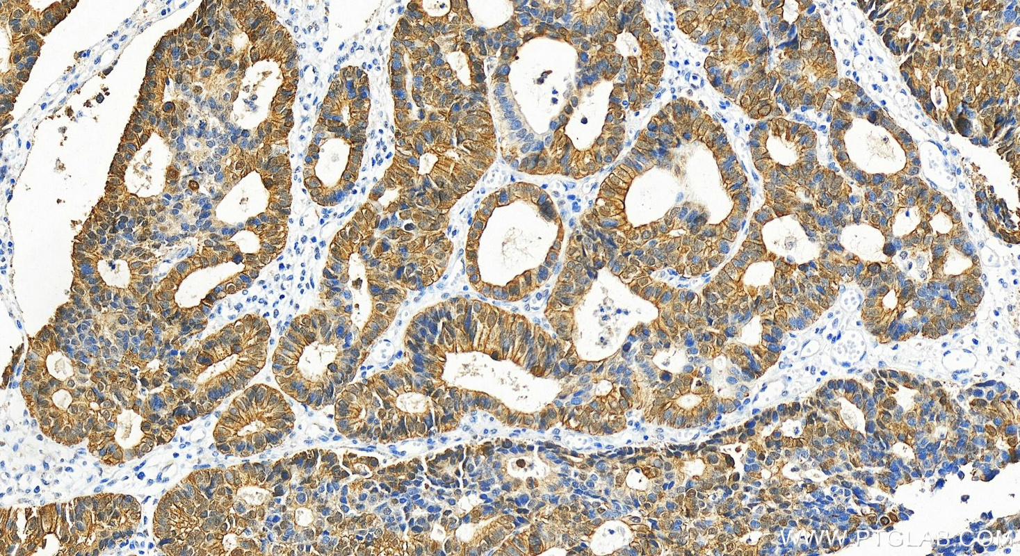 Immunohistochemistry (IHC) staining of human stomach cancer tissue using PSAPL1 Polyclonal antibody (55128-1-AP)