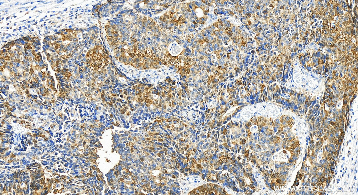 Immunohistochemistry (IHC) staining of human stomach cancer tissue using PSAPL1 Polyclonal antibody (55128-1-AP)