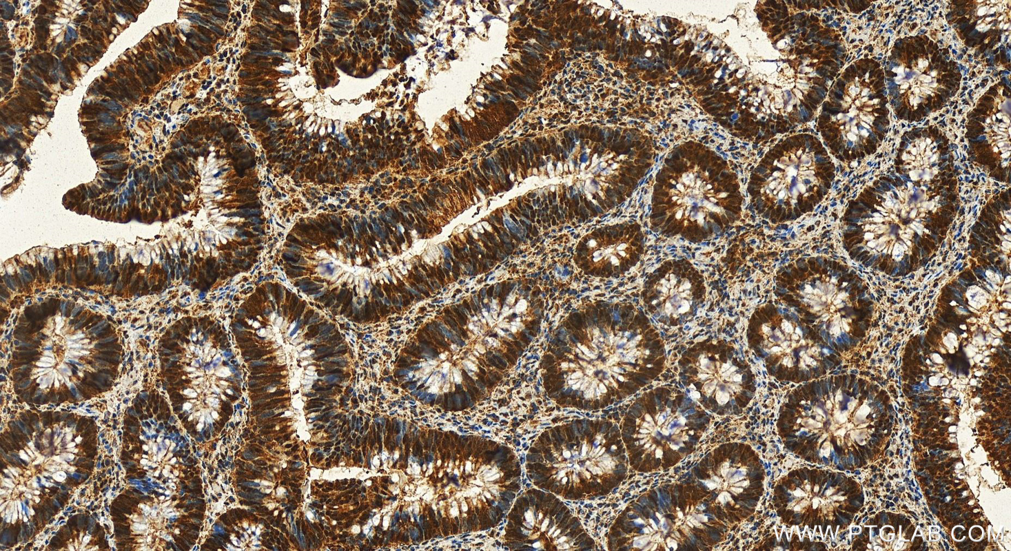 Immunohistochemistry (IHC) staining of human colon cancer tissue using PSMA1 Polyclonal antibody (11175-1-AP)