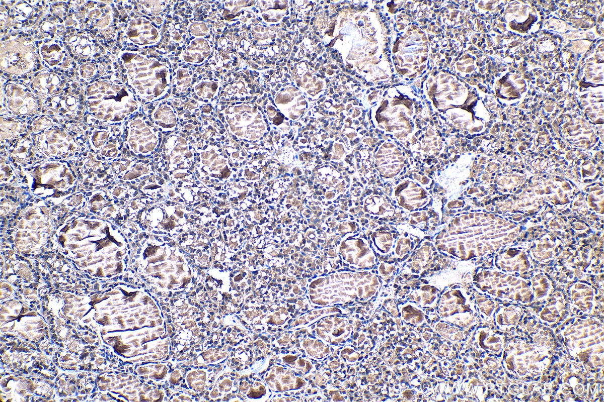 Immunohistochemistry (IHC) staining of human thyroid cancer tissue using PSMB5 Polyclonal antibody (19178-1-AP)