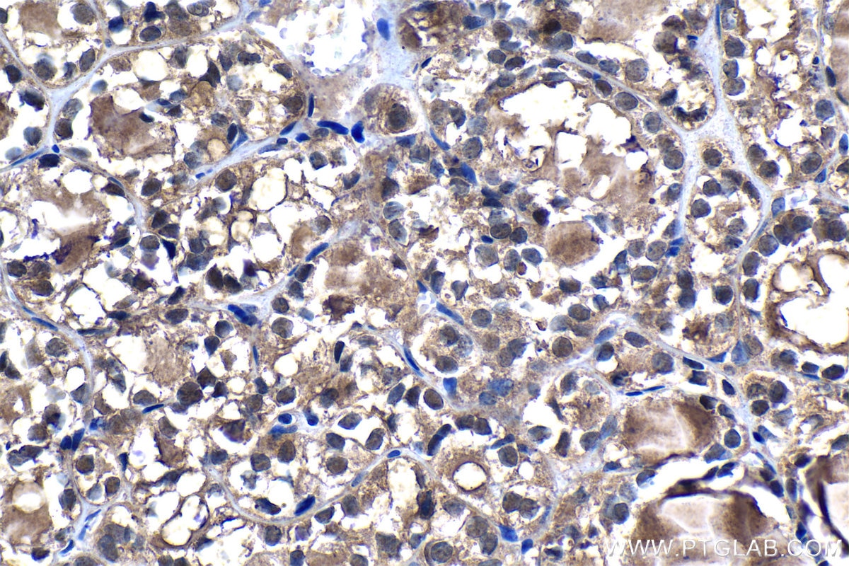 Immunohistochemistry (IHC) staining of human thyroid cancer tissue using PSMB5 Polyclonal antibody (19178-1-AP)