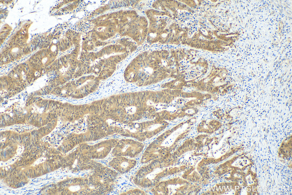 Immunohistochemistry (IHC) staining of human colon cancer tissue using PSMB7 Monoclonal antibody (68641-1-Ig)