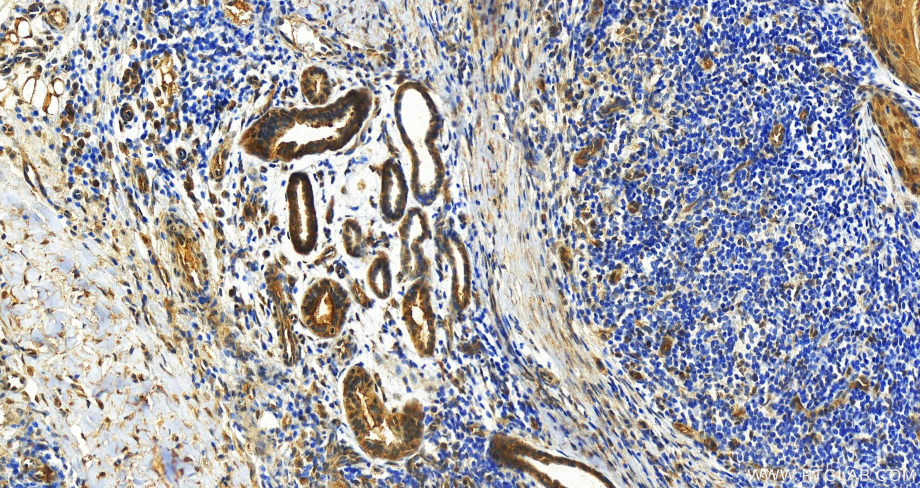 Immunohistochemistry (IHC) staining of human skin cancer tissue using PSMB7 Monoclonal antibody (68641-1-Ig)