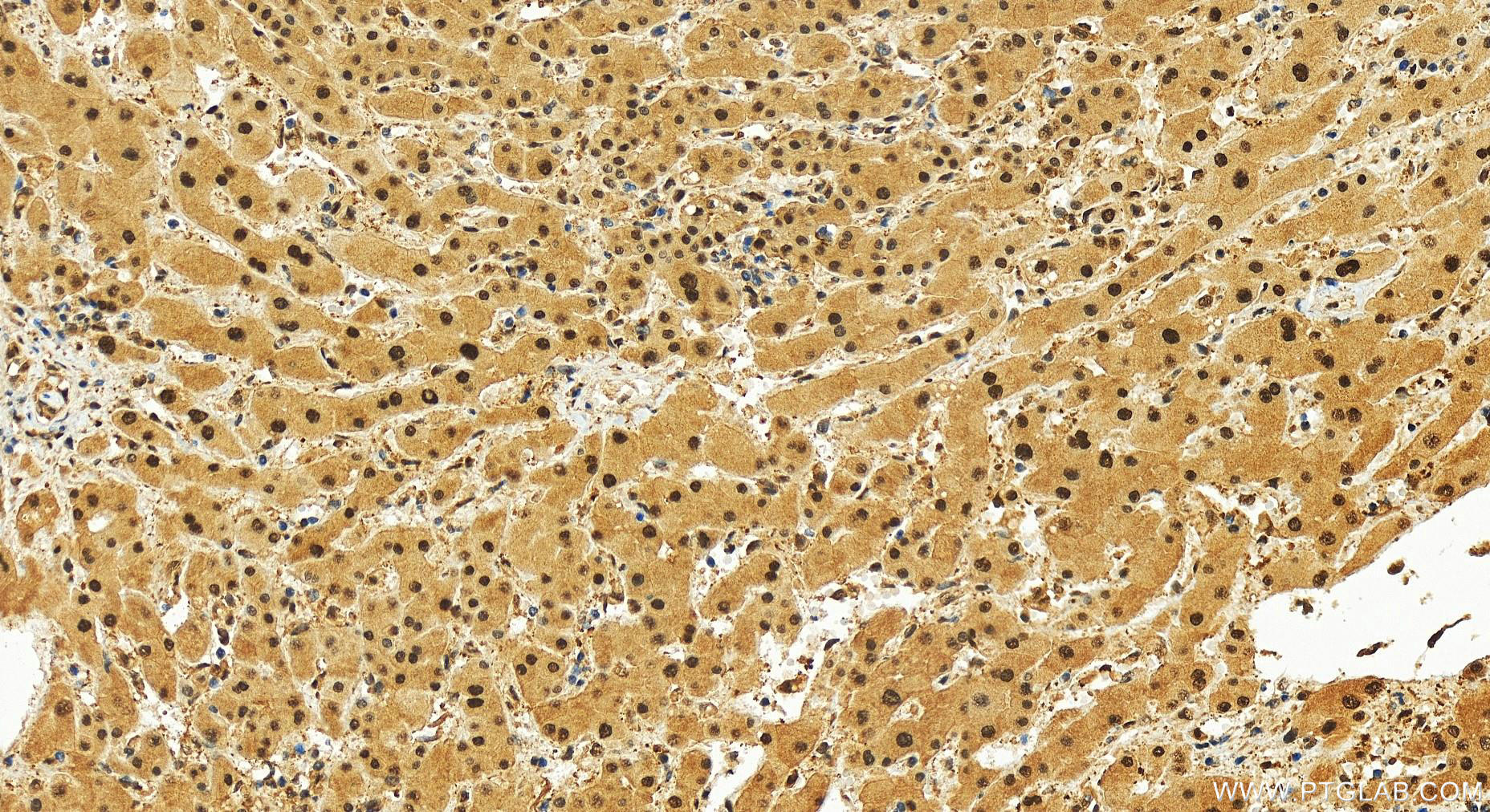 Immunohistochemistry (IHC) staining of human intrahepatic cholangiocarcinoma tissue using PSMD1 Recombinant antibody (83521-2-RR)