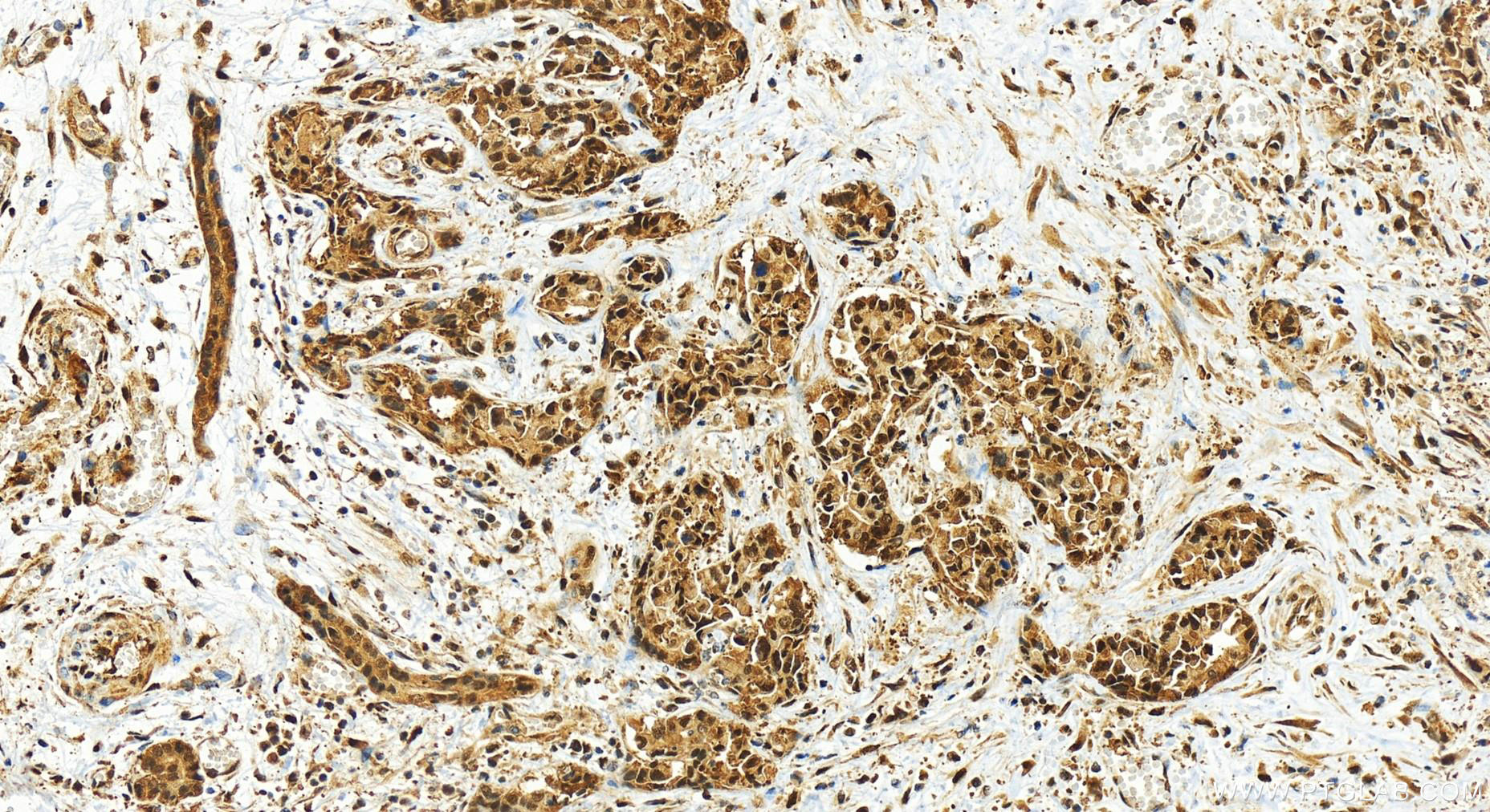 Immunohistochemistry (IHC) staining of human intrahepatic cholangiocarcinoma tissue using PSMD1 Recombinant antibody (83521-2-RR)