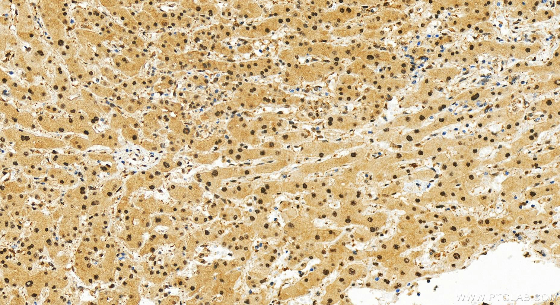 Immunohistochemistry (IHC) staining of human intrahepatic cholangiocarcinoma tissue using PSMD1 Recombinant antibody (83521-4-RR)