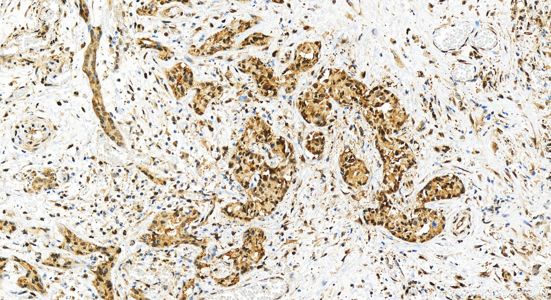 Immunohistochemistry (IHC) staining of human intrahepatic cholangiocarcinoma tissue using PSMD1 Recombinant antibody (83521-4-RR)