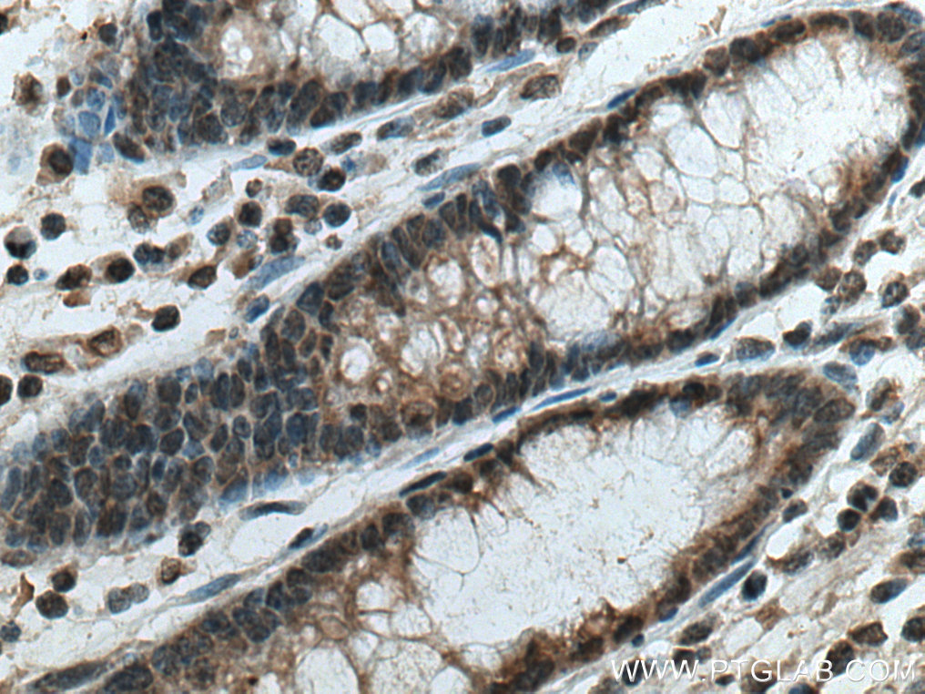 Immunohistochemistry (IHC) staining of human colon cancer tissue using PSMD5 Monoclonal antibody (67682-1-Ig)