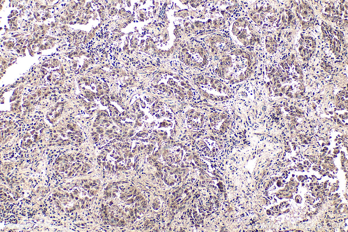 Immunohistochemistry (IHC) staining of human lung cancer tissue using PSMD7 Polyclonal antibody (16034-1-AP)