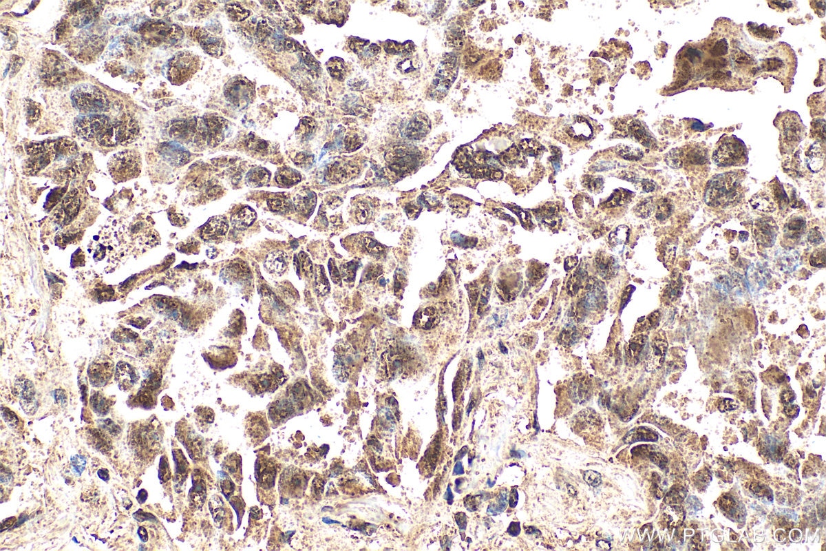 Immunohistochemistry (IHC) staining of human lung cancer tissue using PSMD7 Polyclonal antibody (16034-1-AP)