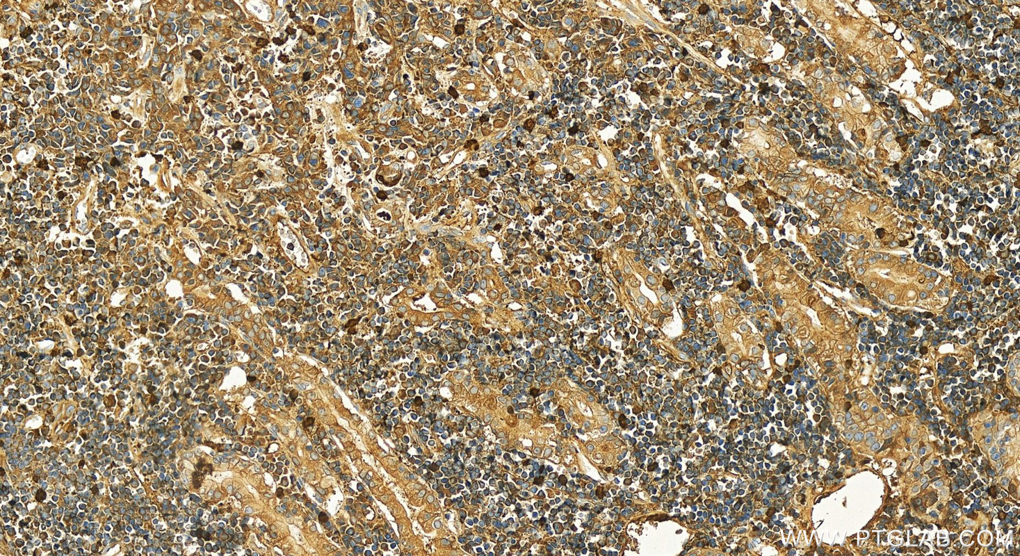 Immunohistochemistry (IHC) staining of human stomach cancer tissue using PSMG3 Polyclonal antibody (15601-1-AP)