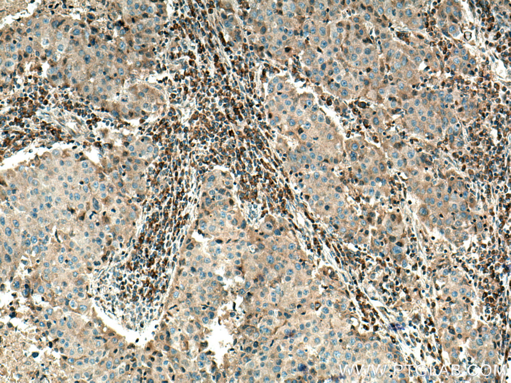 Immunohistochemistry (IHC) staining of human breast cancer tissue using COX2/ Cyclooxygenase 2/ PTGS2 Polyclonal antibody (12375-1-AP)