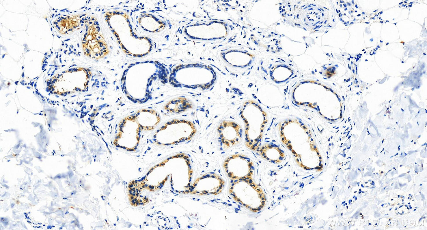 Immunohistochemistry (IHC) staining of human bowen disease using COX2/ Cyclooxygenase 2/ PTGS2 Polyclonal antibody (12375-1-AP)