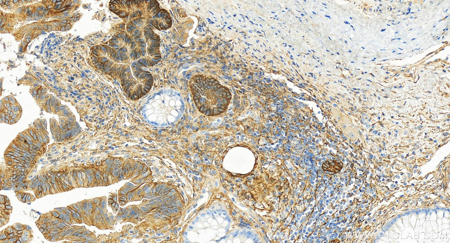 Immunohistochemistry (IHC) staining of human colon cancer tissue using PTK7 Polyclonal antibody (17799-1-AP)