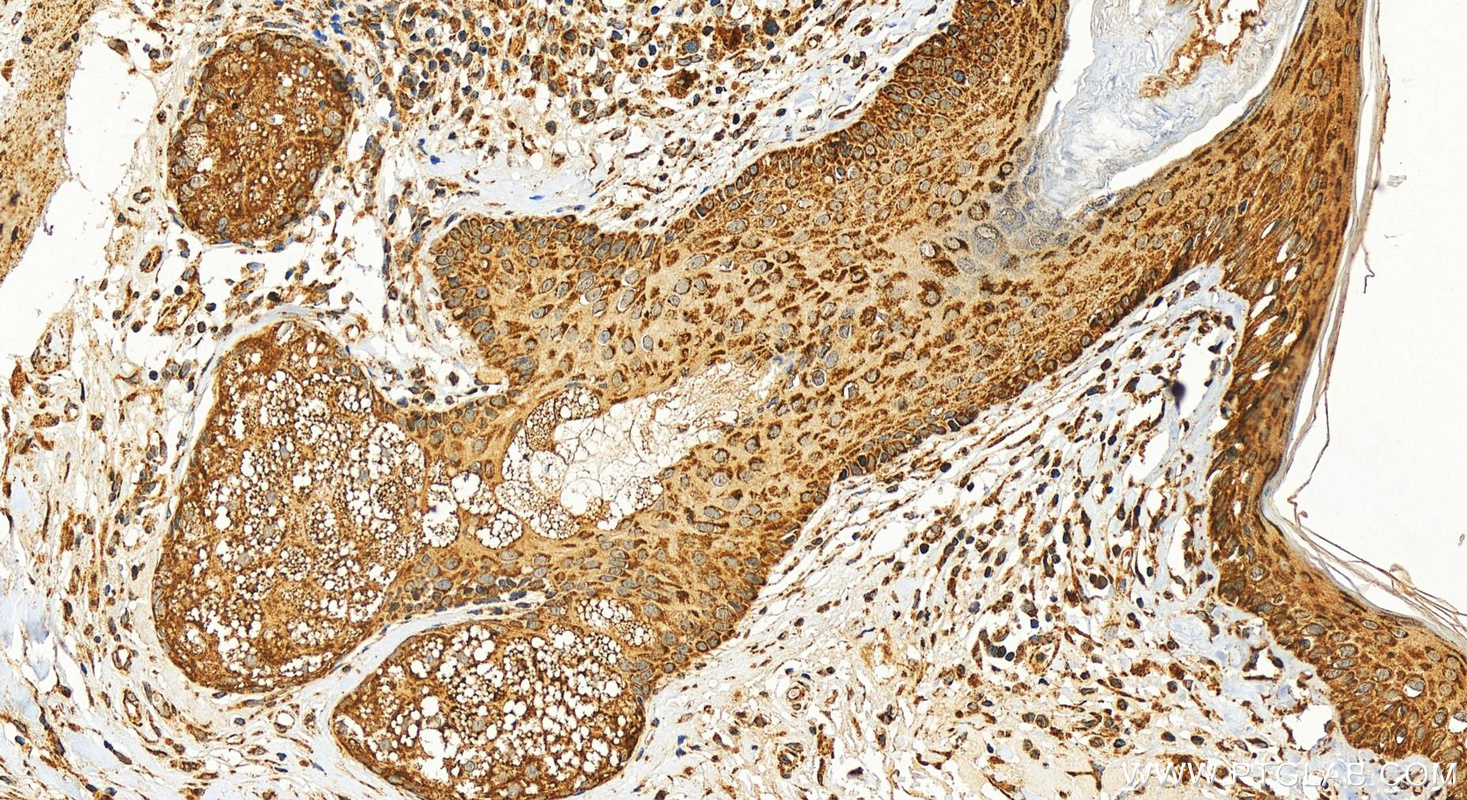 Immunohistochemistry (IHC) staining of human paracancerous of skin cancer using PTPIP51 Polyclonal antibody (20641-1-AP)