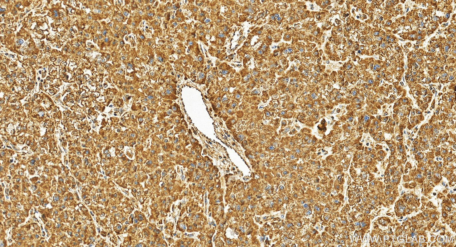 Immunohistochemistry (IHC) staining of human Hepatocellular carcinoma using SHP2 Recombinant monoclonal antibody (82503-1-RR)