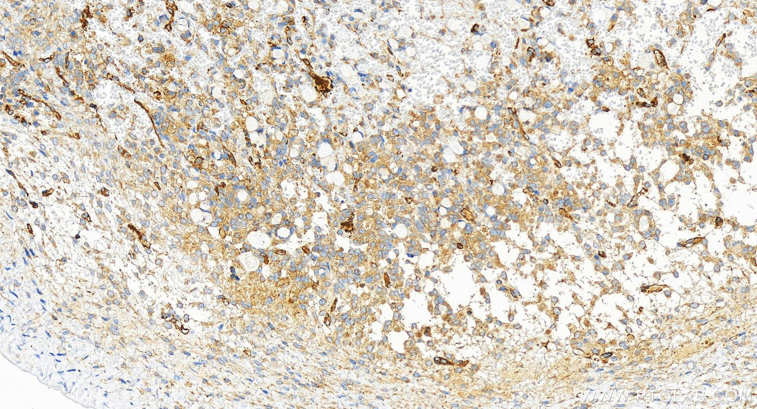 Immunohistochemistry (IHC) staining of human ovary cancer tissue using PTPN12 Recombinant antibody (83851-6-RR)