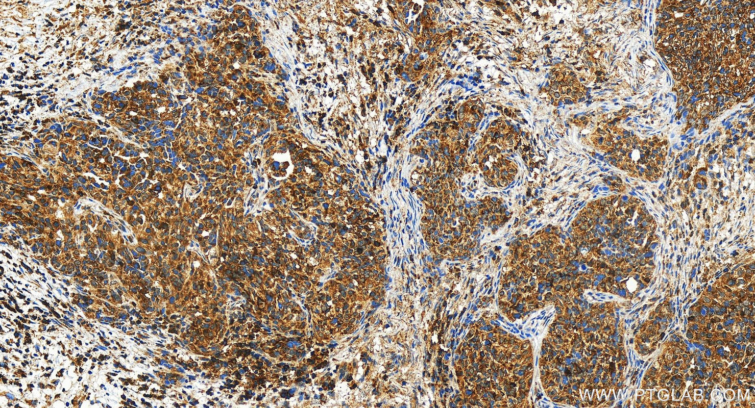 Immunohistochemistry (IHC) staining of human ovary cancer tissue using PTPN6 Polyclonal antibody (24143-1-AP)