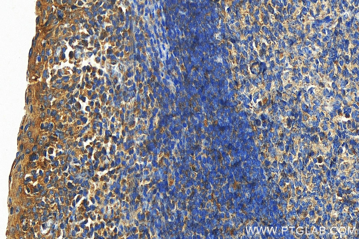 Immunohistochemistry (IHC) staining of human tonsillitis tissue using PVRIG Polyclonal antibody (21448-1-AP)