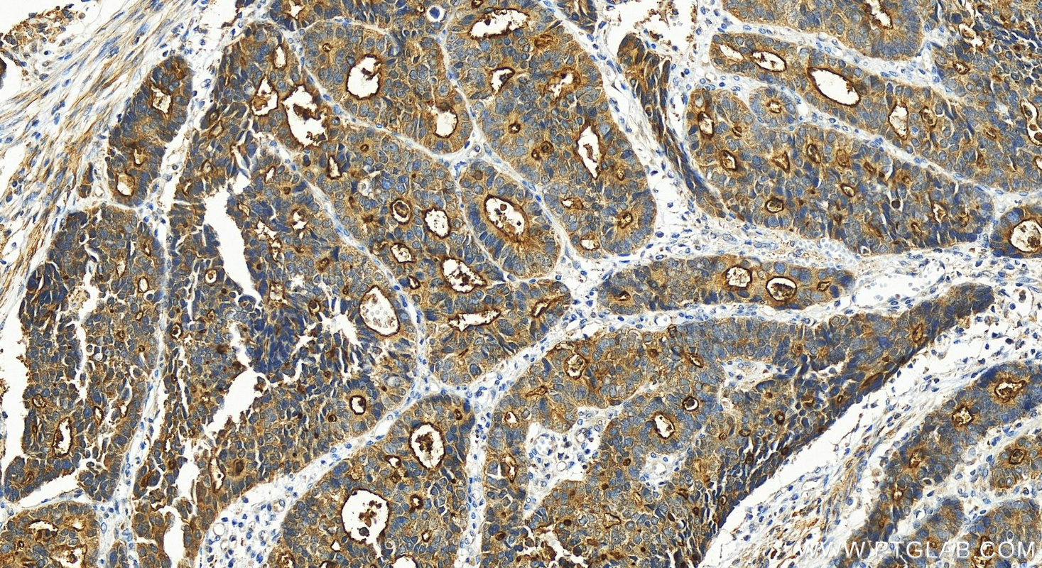 Immunohistochemistry (IHC) staining of human stomach cancer tissue using PYCR2-specific Polyclonal antibody (55060-1-AP)