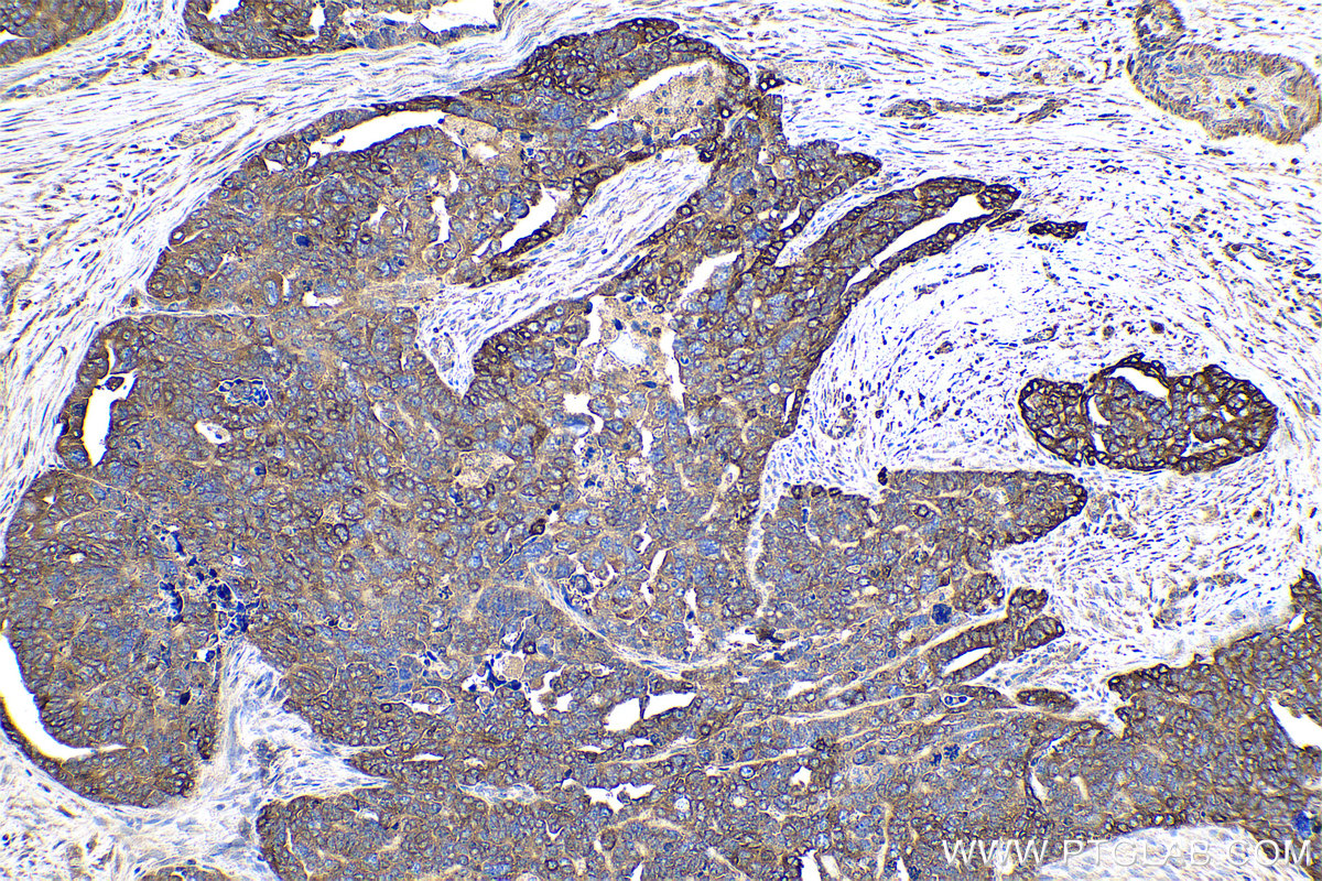 Immunohistochemistry (IHC) staining of human ovary tumor tissue using PYGB Polyclonal antibody (12075-1-AP)