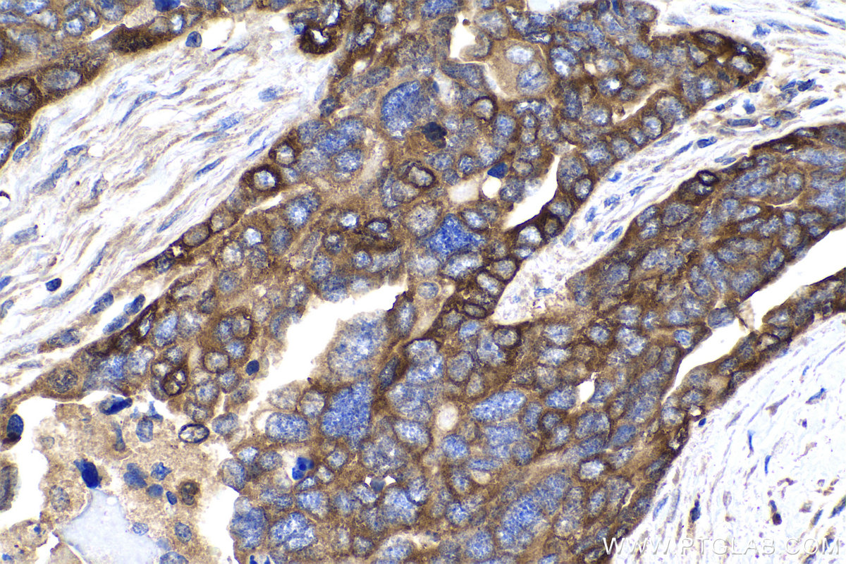 Immunohistochemistry (IHC) staining of human ovary tumor tissue using PYGB Polyclonal antibody (12075-1-AP)