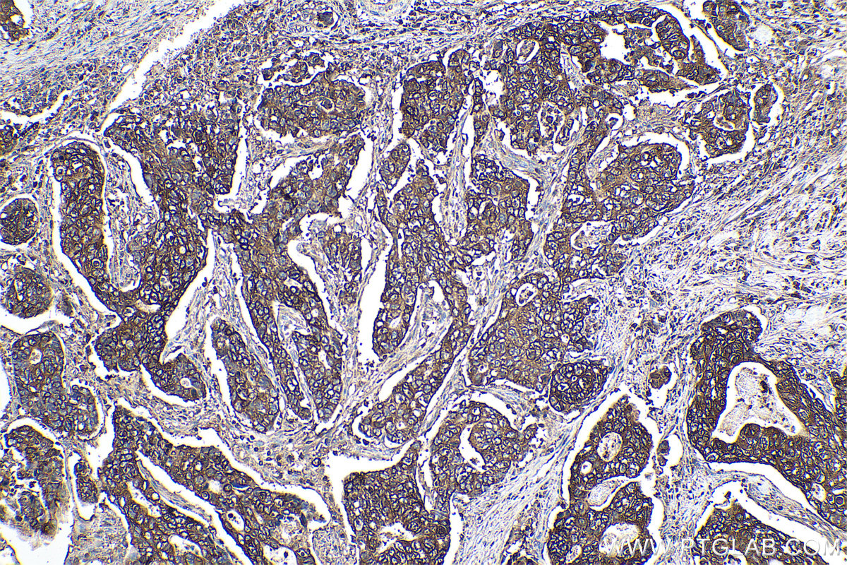 Immunohistochemistry (IHC) staining of human stomach cancer tissue using PYGB Polyclonal antibody (12075-1-AP)