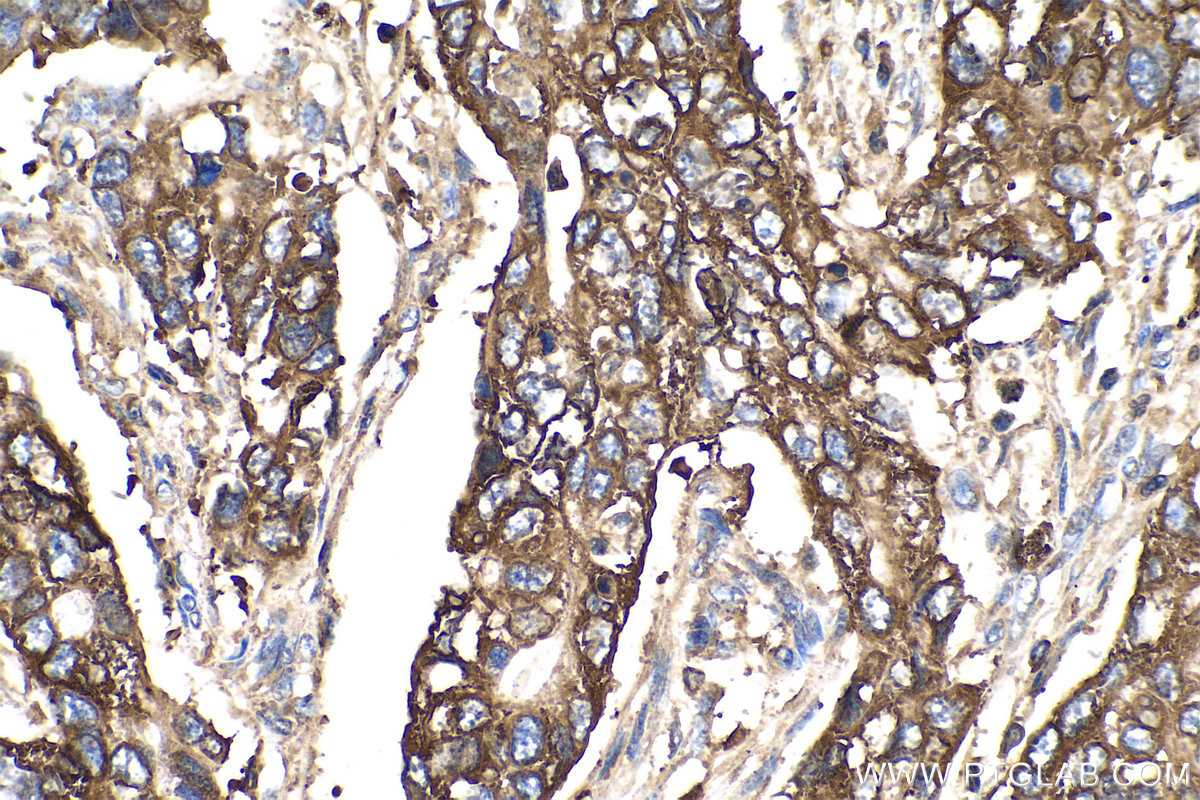 Immunohistochemistry (IHC) staining of human stomach cancer tissue using PYGB Polyclonal antibody (12075-1-AP)