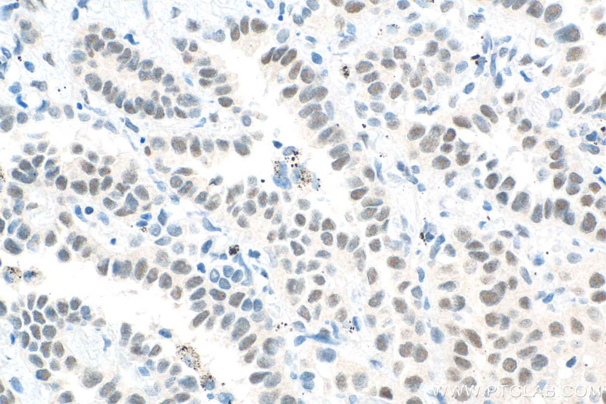 Immunohistochemistry (IHC) staining of human lung cancer tissue using PYGO2 Polyclonal antibody (11555-1-AP)