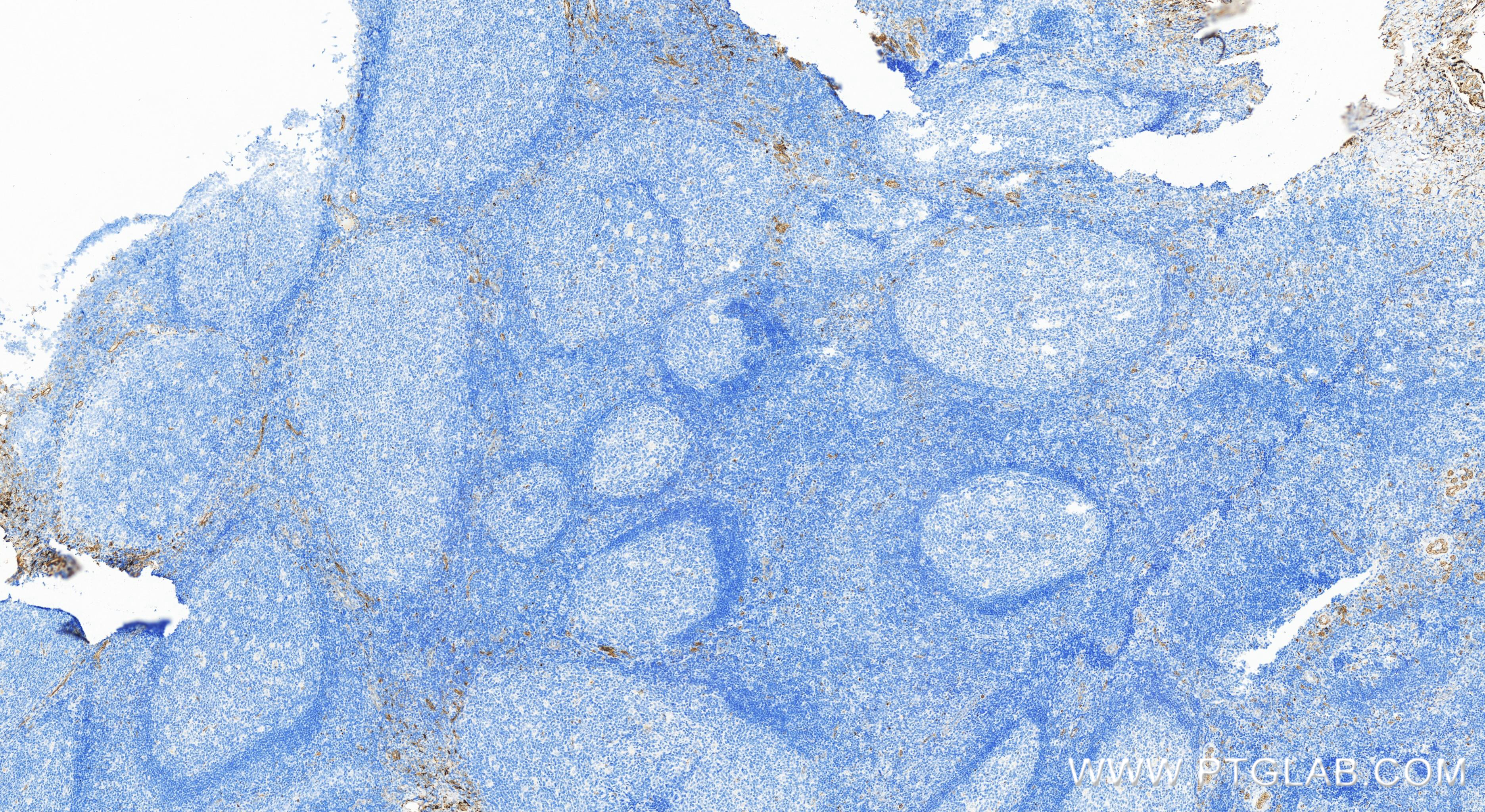 Immunohistochemistry (IHC) staining of human tonsillitis tissue using Perforin Recombinant antibody (83977-1-RR)